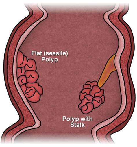 They may appear alone or in clusters, and grow quite large. . External polyps on anus